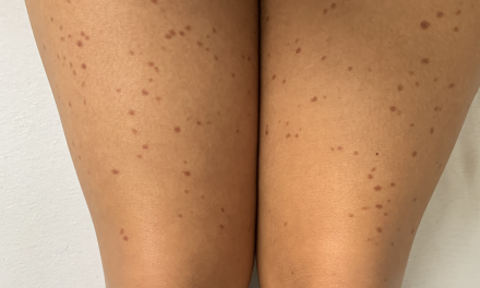 ‘Ik had mijn broek nog niet uit en ze zei al dat het mastocytose was.’