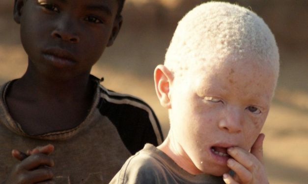 Tussen licht en duisternis; de gevaren en realiteit van albino’s in Afrika