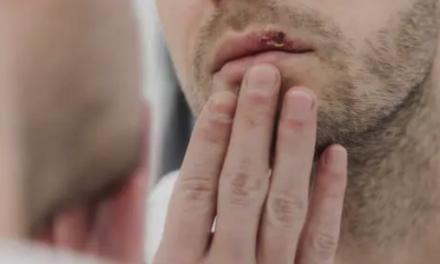 FACTCHECK: Meeste herpesbesmettingen vinden plaats zonder zichtbare blaasjes