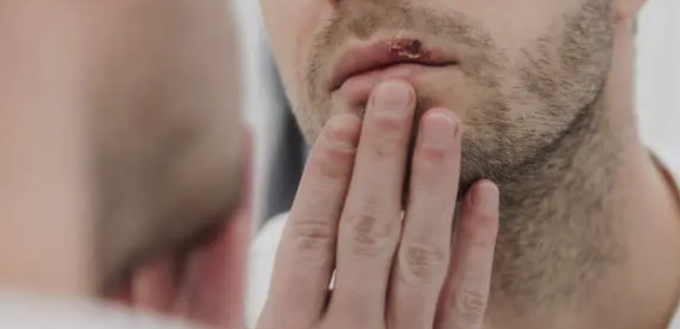 FACTCHECK: Meeste herpesbesmettingen vinden plaats zonder zichtbare blaasjes