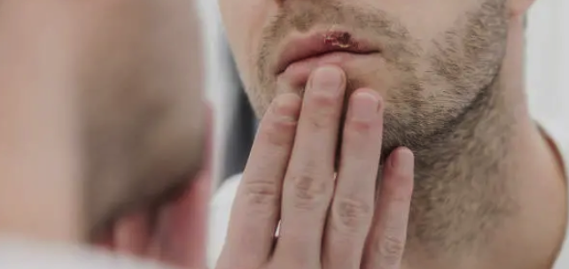 FACTCHECK: Meeste herpesbesmettingen vinden plaats zonder zichtbare blaasjes